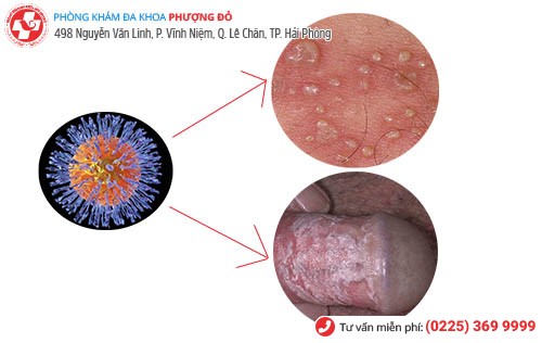 virut gây bệnh mụn rộp sinh dục