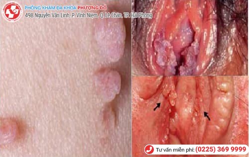 mụn sinh dục