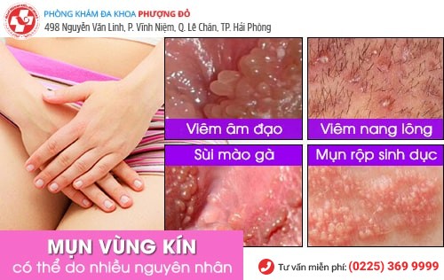 mụn vùng kín nữ mụn vùng kín nữ