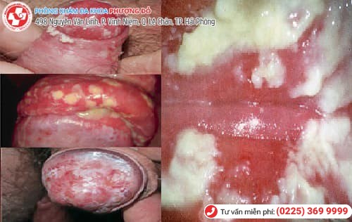 nấm bộ phận sinh dục