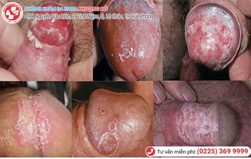 hình ảnh nấm candida