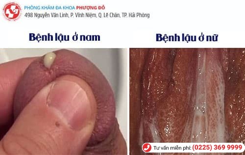 ngứa rát bộ phận sinh dục