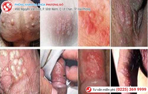 nổi mụn dương vật