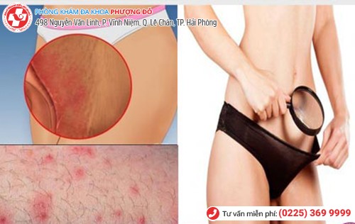Hình ảnh nổi mụn ở háng nữ Hình ảnh nổi mụn ở háng nữ