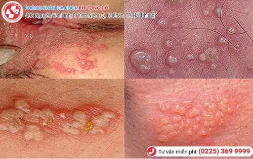 nổi mụn vùng kín