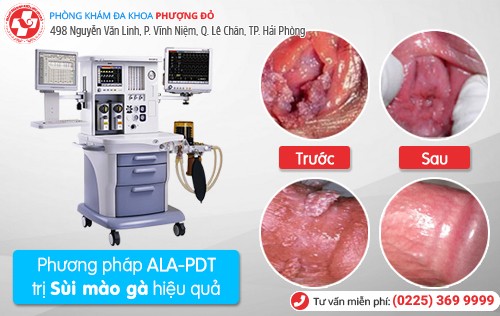 Biểu hiện bệnh sùi mào gà Biểu hiện bệnh sùi mào gà