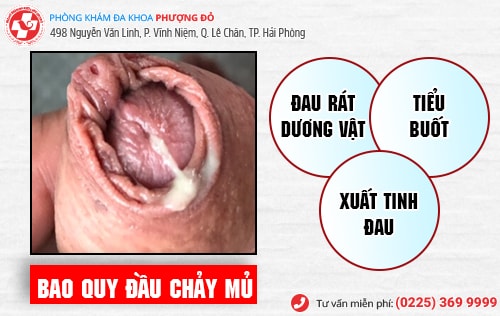 Bao quy đầu chảy mủ - Cẩn thận bệnh lậu! Bao quy đầu chảy mủ - Cẩn thận bệnh lậu!