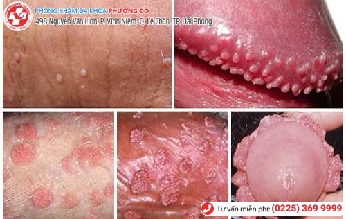 Sùi mào gà ở cơ quan sinh dục nam Sùi mào gà ở cơ quan sinh dục nam
