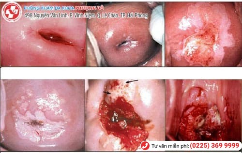 sùi mào gà ở cổ tử cung sùi mào gà ở cổ tử cung