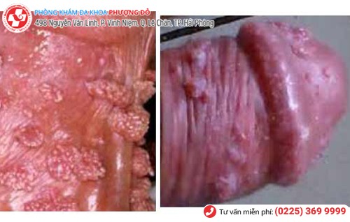 hình ảnh sùi mào gà dương vật