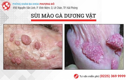 sùi mào gà dương vật sùi mào gà dương vật