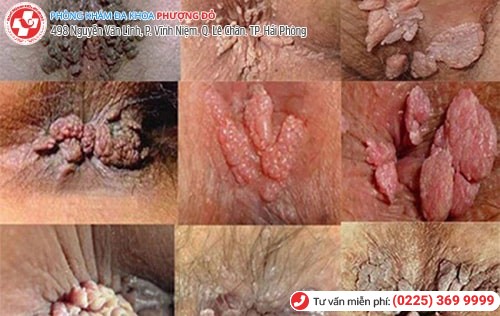 Sùi mào gà ở hậu môn Sùi mào gà ở hậu môn