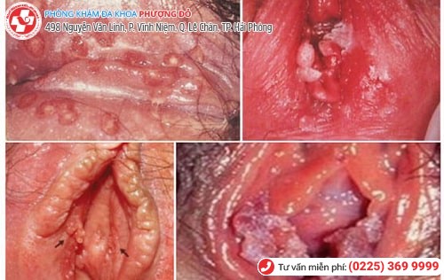 Sùi mào gà ở cơ quan sinh dục nữ Sùi mào gà ở cơ quan sinh dục nữ