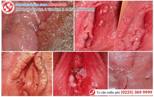 Sùi mào gà ở cơ quan sinh dục nữ