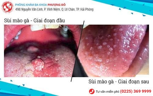 sùi mào gà ở miệng sùi mào gà ở miệng