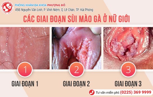 Sùi mào gà ở môi lớn môi bé qua các giai đoạn Sùi mào gà ở môi lớn môi bé qua các giai đoạn
