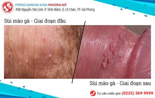 sùi mào gà ở nam sùi mào gà ở nam