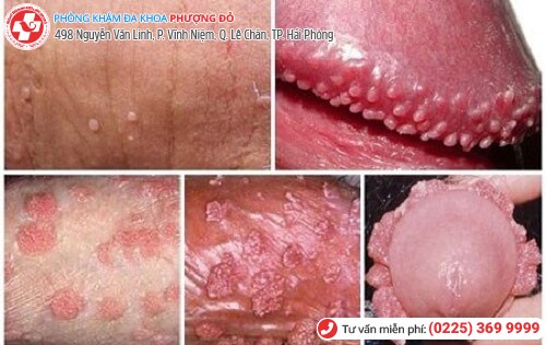 Sùi mào gà ở vùng kín nam Sùi mào gà ở vùng kín nam