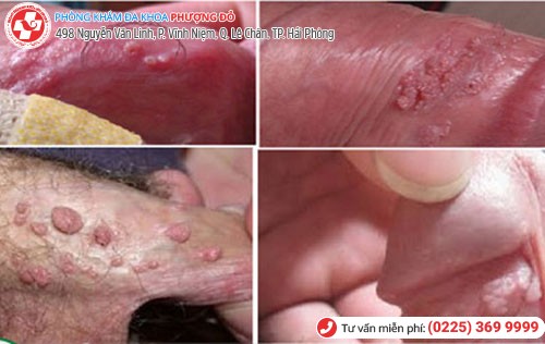 Hình ảnh sùi mào gà Hình ảnh sùi mào gà