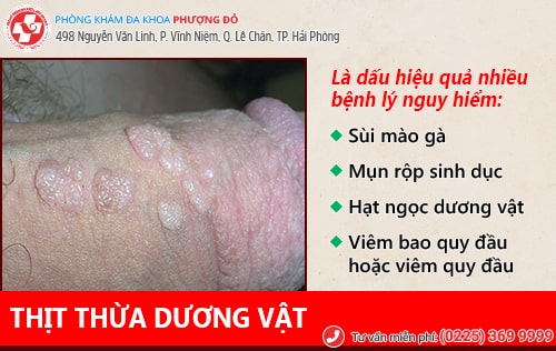 Nam giới cần cảnh giác với thịt thừa dương vật Nam giới cần cảnh giác với thịt thừa dương vật