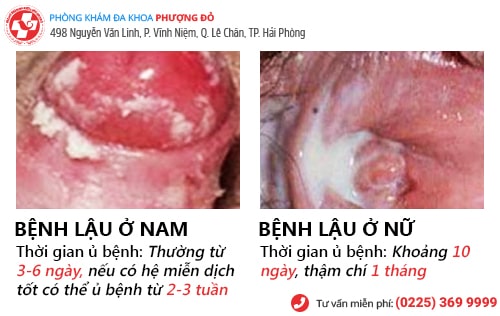 thời gian ủ bệnh lậu thời gian ủ bệnh lậu