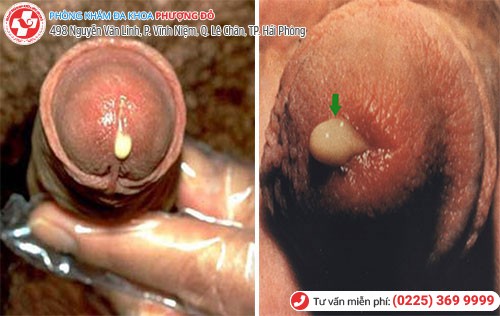 Bệnh lậu khiến nam giới đi tiểu ra mủ Bệnh lậu khiến nam giới đi tiểu ra mủ