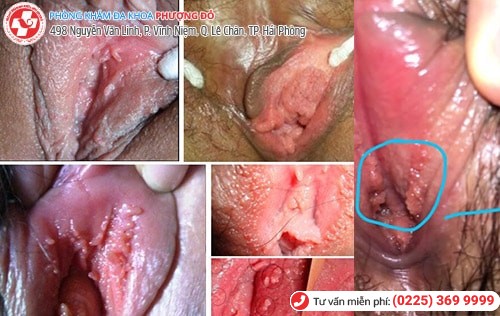 Trải lòng của một sinh viên mắc sùi mào gà Trải lòng của một sinh viên mắc sùi mào gà