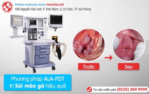 Trải lòng của một sinh viên mắc sùi mào gà Trải lòng của một sinh viên mắc sùi mào gà
