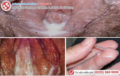 Bệnh lậu ở nữ Bệnh lậu ở nữ
