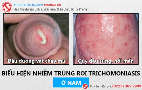 Biểu hiện nhiễm Trichomonas ở nam giới Biểu hiện nhiễm Trichomonas ở nam giới
