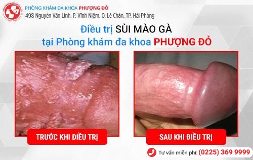 Hình ảnh trước và sau khi điều trị sùi mào gà Hình ảnh trước và sau khi điều trị sùi mào gà