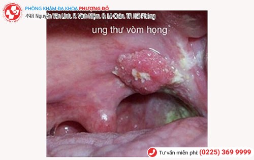 Nguy cơ ung thư vòm họng do bị sùi mào gà ở lưỡi