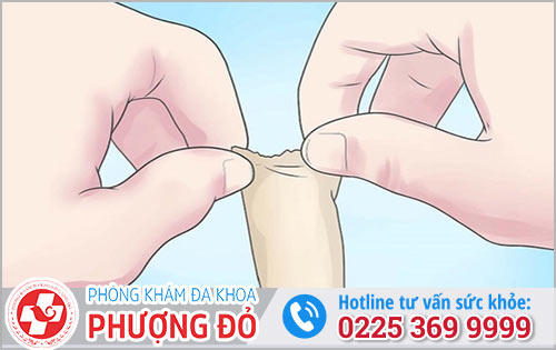 Một số trường hợp bất thường điển hình ở bao quy đầu