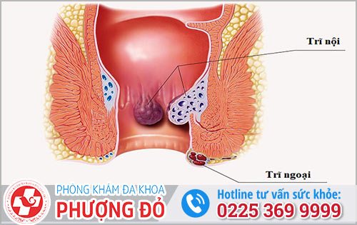 Một Số Dạng Bệnh Trĩ Thường Gặp