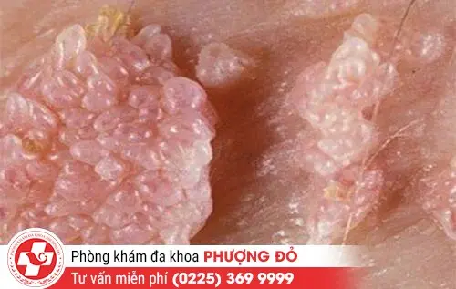 thịt thừa vùng kín