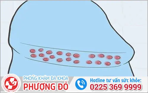 Hạt Ngọc Dương Vật Ở Nam Giới