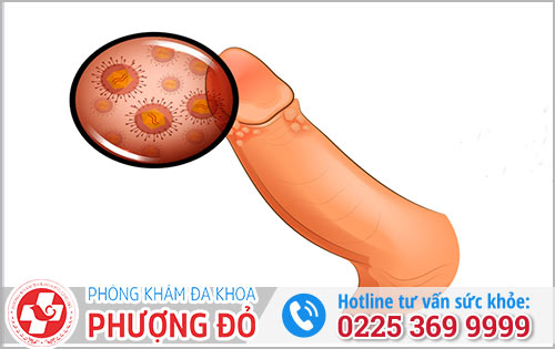 Mụn dương vật có liên quan đến sùi mào gà không?