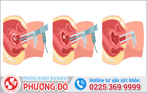 Thai 11 tuần bằng cách nào là hiệu quả