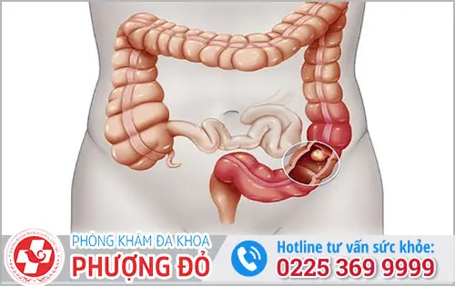 Nguyên Nhân Gây Bệnh Viêm Trực Tràng